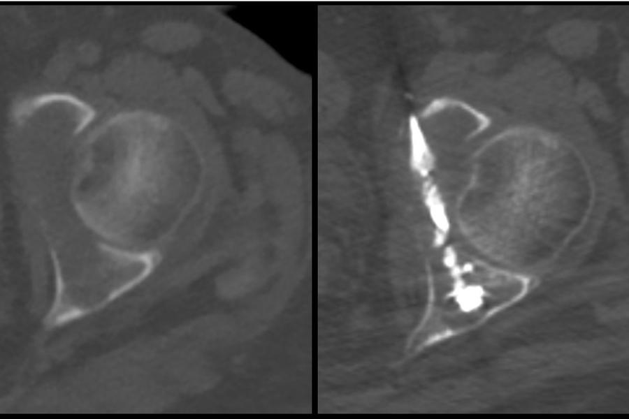 Photo of cementoplasty